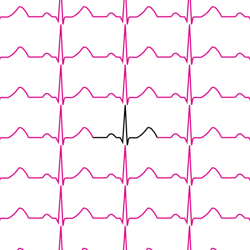 Normal Sinus ECG