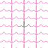 Normal Sinus ECG