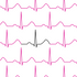 Normal Sinus ECG