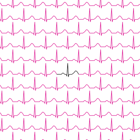 Normal Sinus ECG