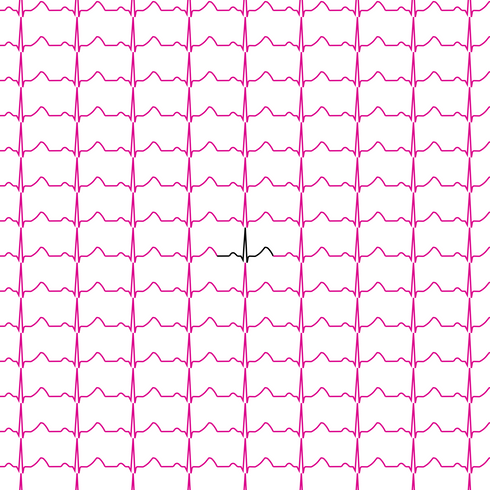 Normal Sinus ECG