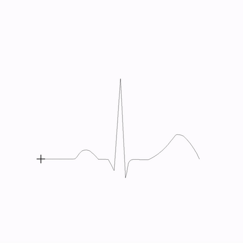 Normal Sinus ECG